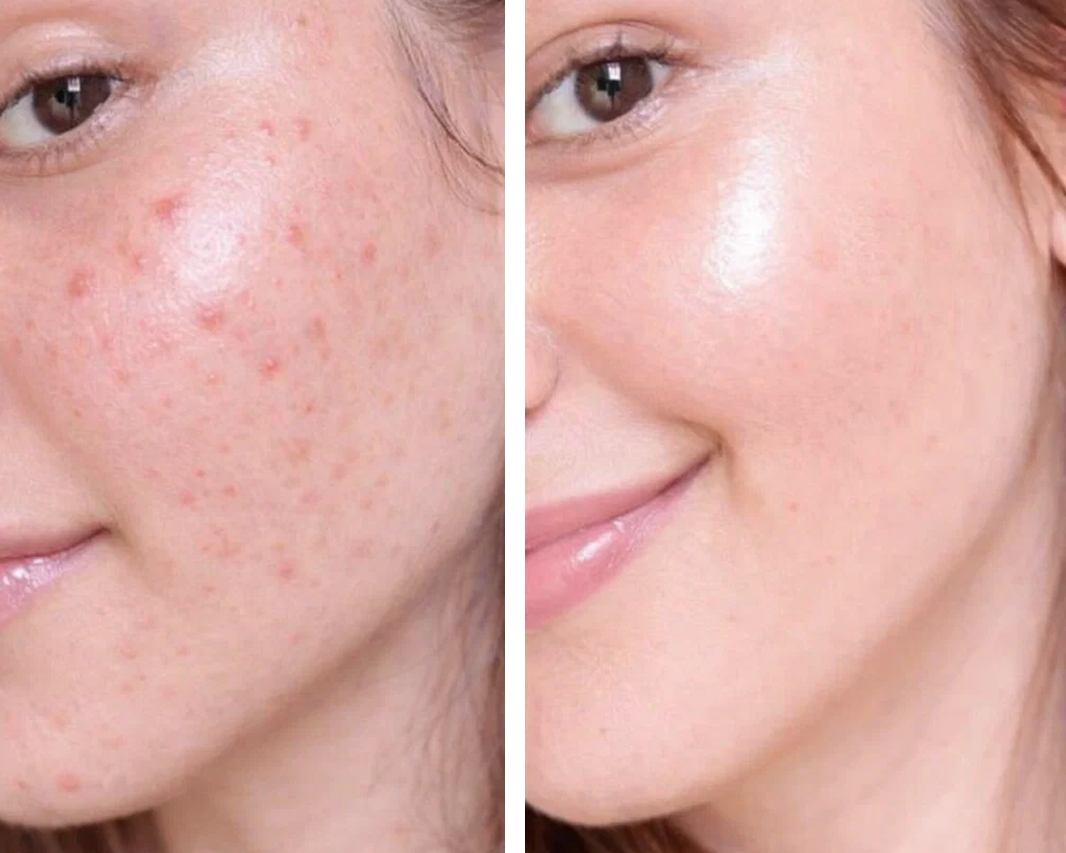 Acne Scar Treatment: What Actually Helps, What Doesn’t, and How to Choose the Right Option