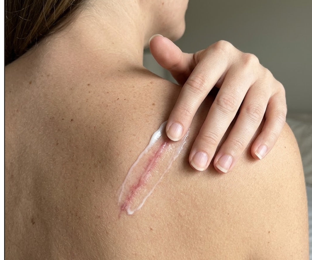 Best scar gel