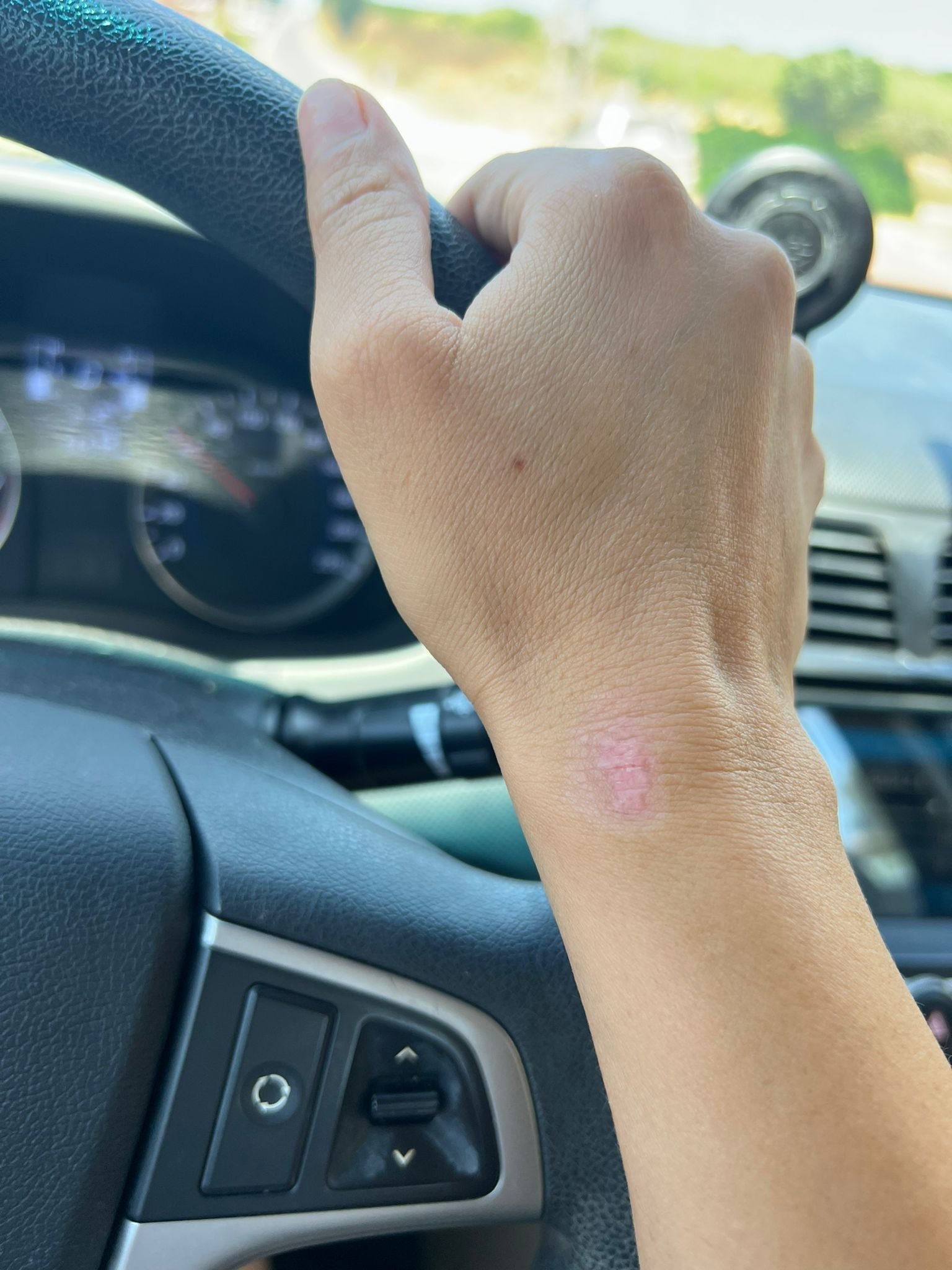 Best Burn Cream for Burns, Blisters & Damaged Skin