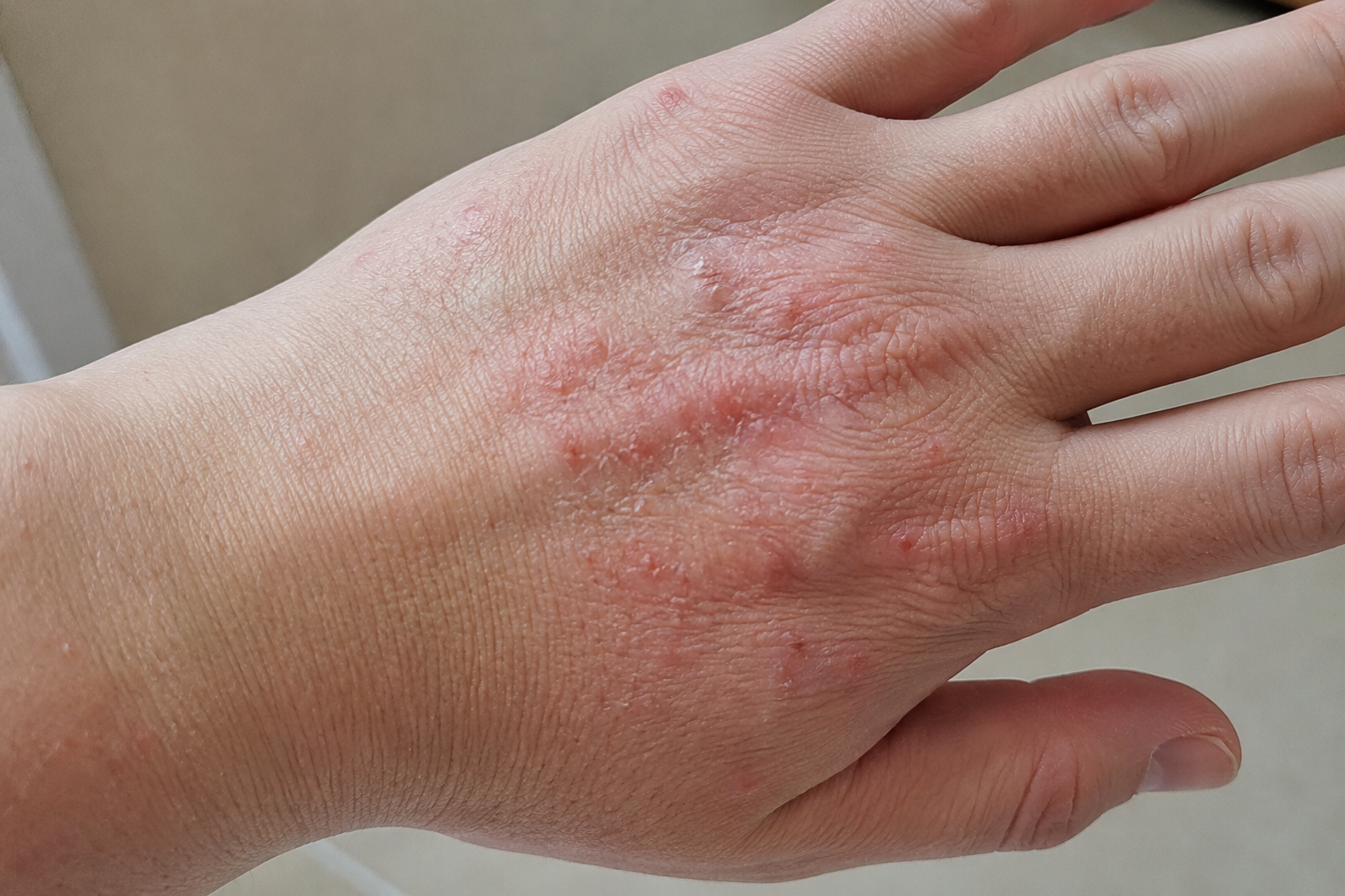 When Eczema Needs Medical Treatment: Signs It’s Time to See a Doctor