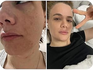 Best Psoriasis Cream