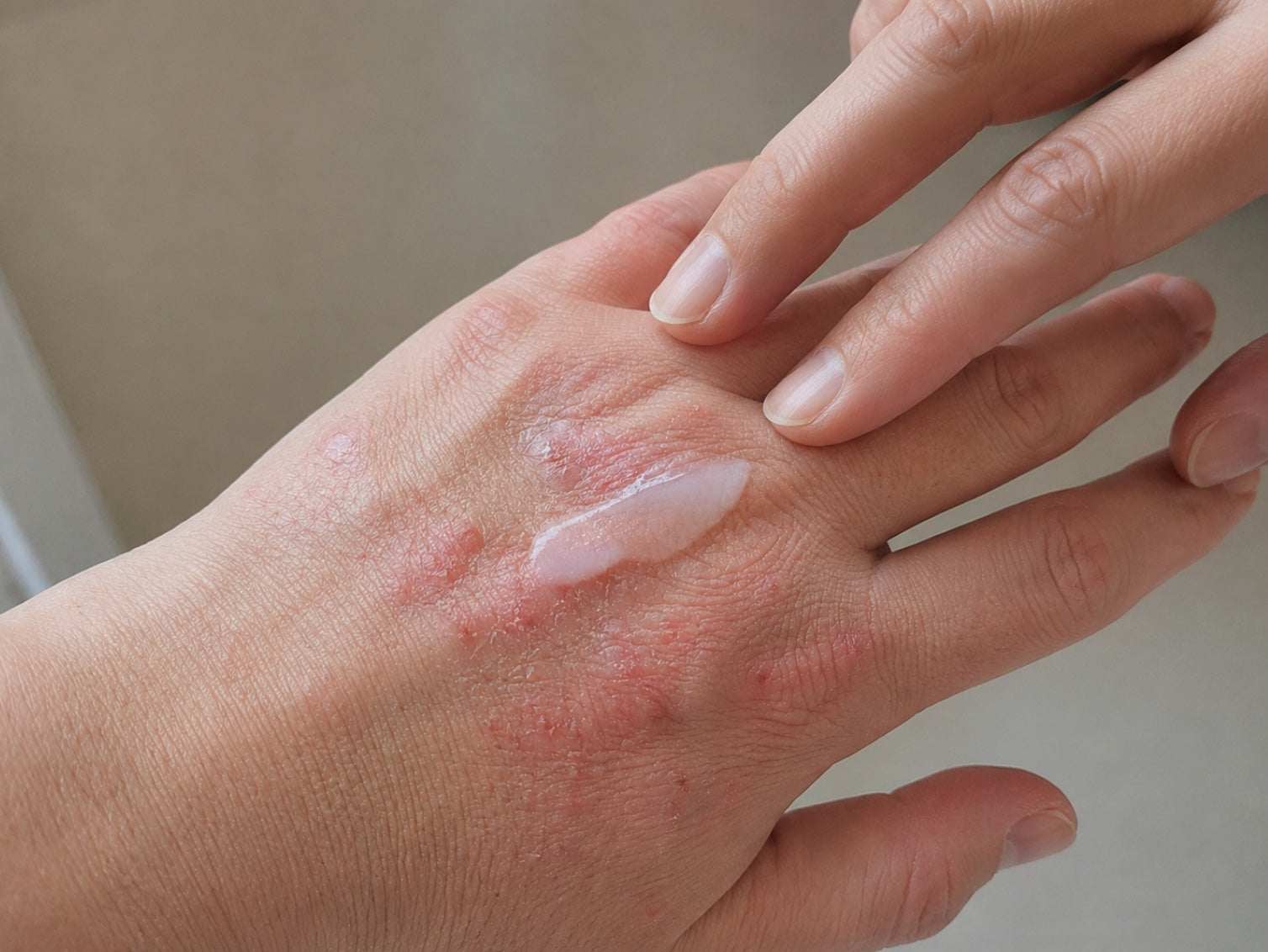 Best Cream for Itchy Skin Rash, Dryness & Allergy
