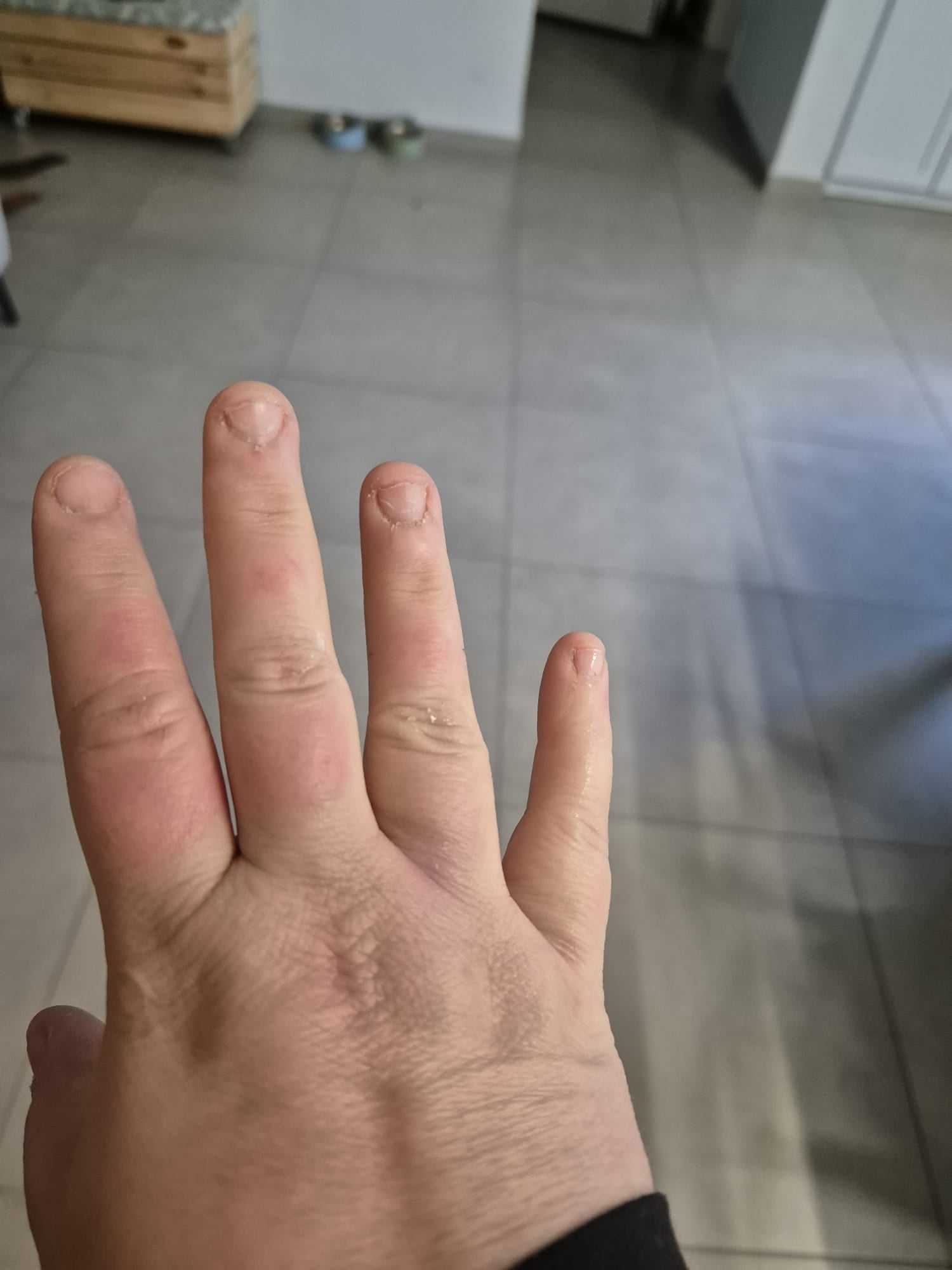 burn scar