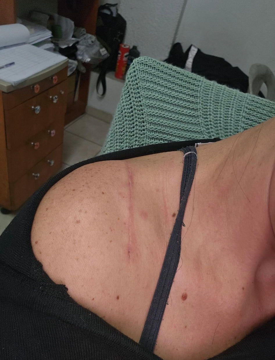 Best Scar Cream: What Actually Helps New and Old Scars Fade