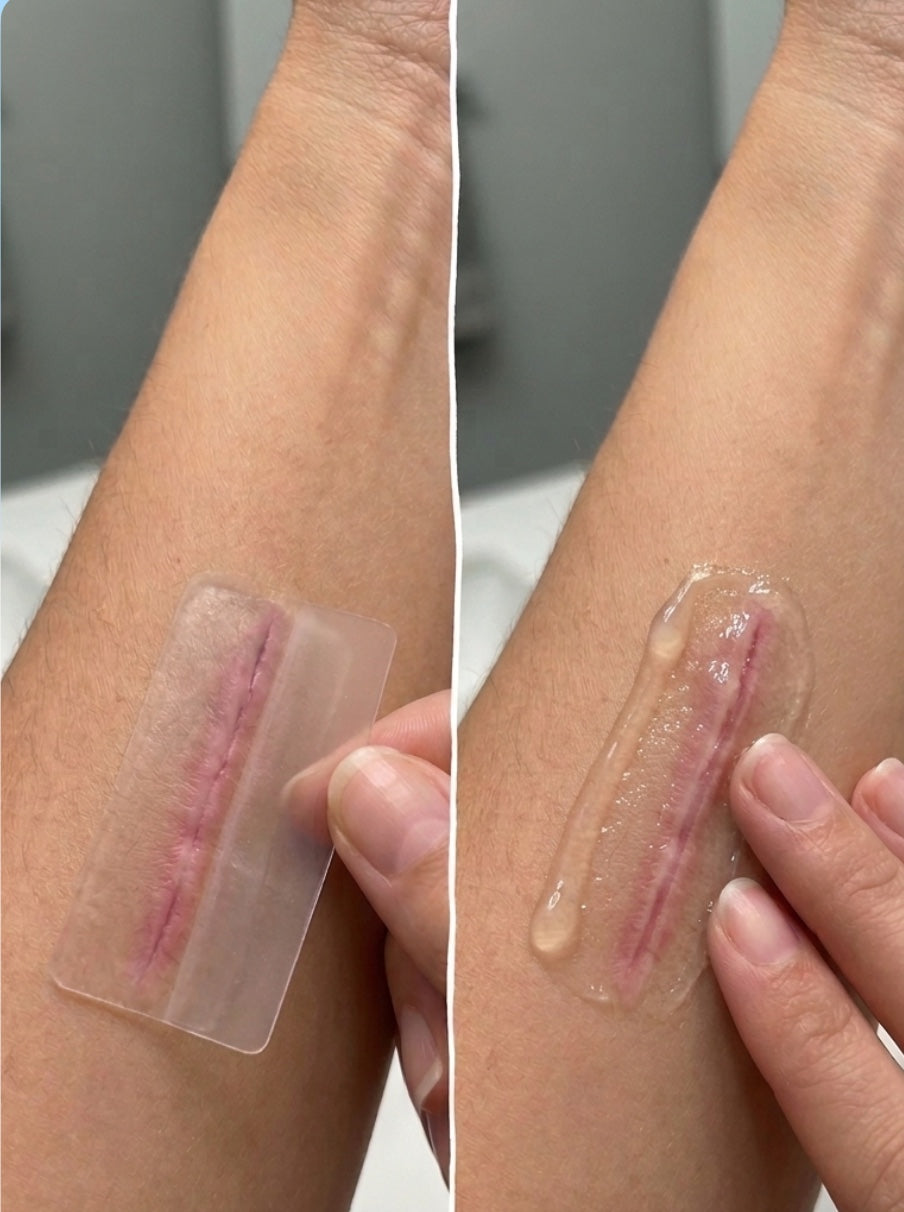Silicone Gel vs Sheets: Which Scar Treatment Makes More Sense for Your Scar?