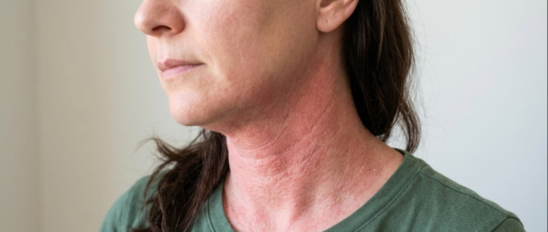 Topical Steroid Withdrawal: Symptoms, Causes, Treatment, and How to Avoid It