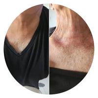 I.G - Treatment for burns caused by radiation therapy