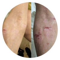 Y.B – Treatment for Atopic Dermatitis (Eczema)