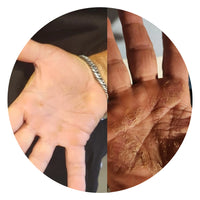 Y.S – Diagnosed with Psoriasis.