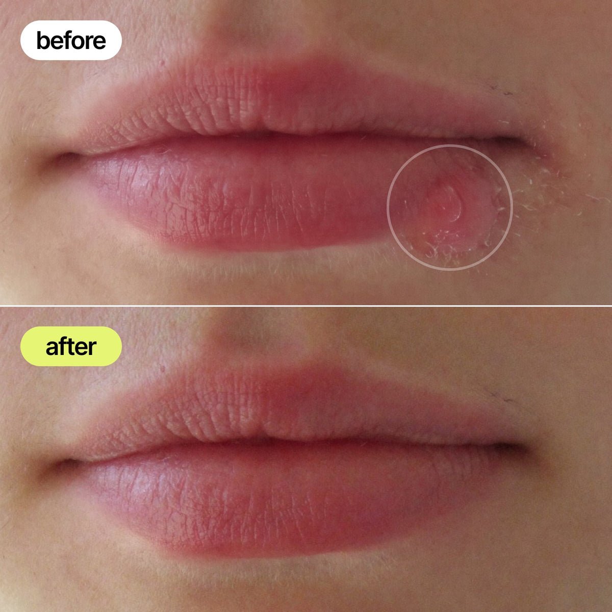 Illustrative before and after: lower lip with redness, then the same lip clear